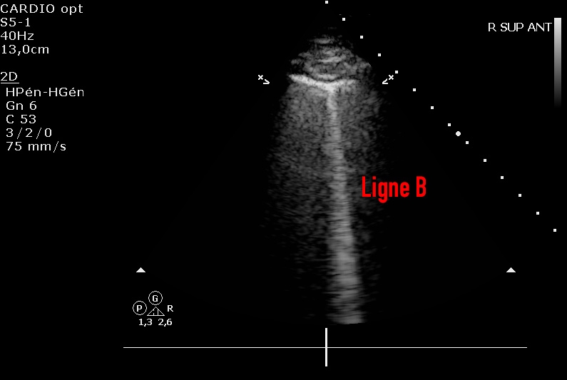 Echographie pulmonaire d&#039;un patient COVID-19